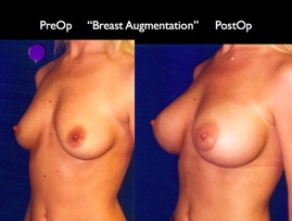 Breast-Aug2.035.jpg