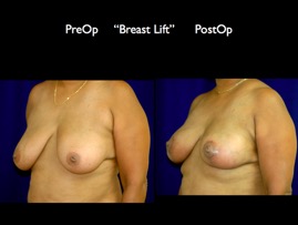 BreastLift.002.jpg