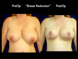 Breast Reduction.001.jpg