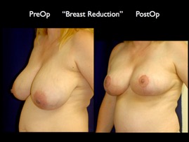 Breast Reduction.002.jpg