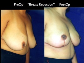 BreastReduc2.004.jpg
