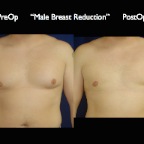 gynecomastia.001