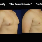 gynecomastia.002