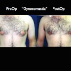 gynecomastia.004