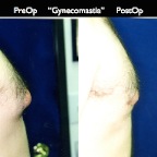 gynecomastia.005