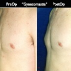 gynecomastia.006