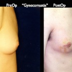 gynecomastia.008