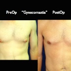 gynecomastia.009