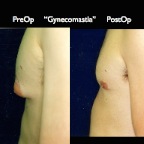 gynecomastia.010