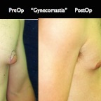 gynecomastia.011