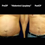 Liposuction.008