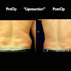 Liposuction.009