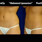 Liposuction.010