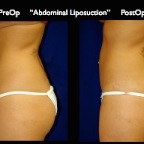 Liposuction.011