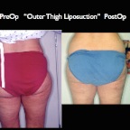 Liposuction.012