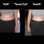 TummyTuck.001