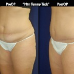 TummyTuck.002