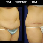 TummyTuck.003