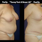 TummyTuck.004