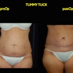 TummyTuck.005