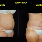 TummyTuck.006