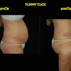 TummyTuck.007