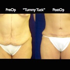 TummyTuck.008