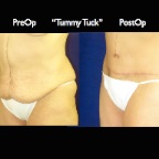 TummyTuck.009