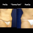 TummyTuck.010