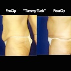 TummyTuck.011