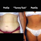 TummyTuck.012