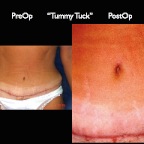 TummyTuck.013