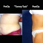 TummyTuck.014