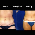 TummyTuck.015