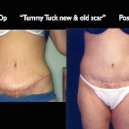 TummyTuck.018