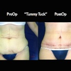 TummyTuck.021