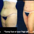 TummyTuck.022