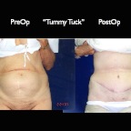 TummyTuck.024