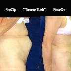 TummyTuck.026