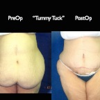 TummyTuck.027