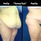 TummyTuck.028