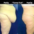 TummyTuck.029