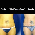 TummyTuck.030