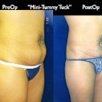 TummyTuck.031