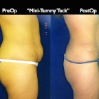 TummyTuck.032