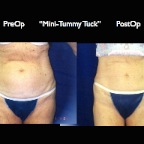 TummyTuck.033