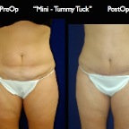 TummyTuck.036