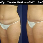 TummyTuck.037