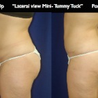 TummyTuck.038