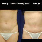 TummyTuck.039